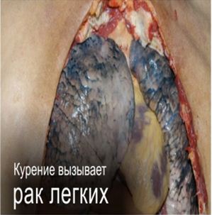 Kazakhstan 2013 Health Effects lung - lung cancer, diseased organ